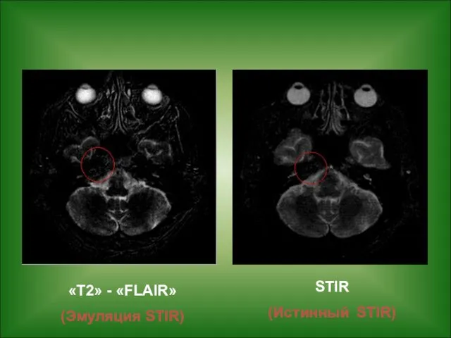 «Т2» - «FLAIR» (Эмуляция STIR) STIR (Истинный STIR)