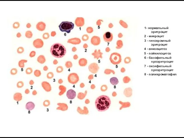 1- нормальный эритроцит 2 - микроцит 3 - гипохромный эритроцит 4