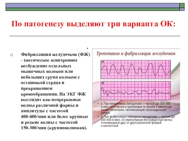 По патогенезу выделяют три варианта ОК: • Фибрилляция желудочков (ФЖ) -