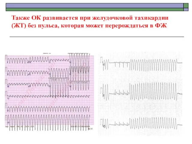 Также ОК развивается при желудочковой тахикардии (ЖТ) без пульса, которая может перерождаться в ФЖ