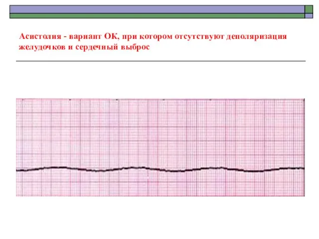 Асистолия - вариант ОК, при котором отсутствуют деполяризация желудочков и сердечный выброс