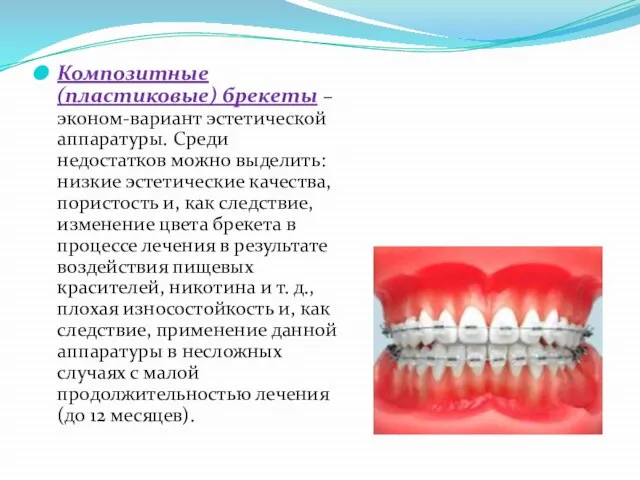 Композитные (пластиковые) брекеты – эконом-вариант эстетической аппаратуры. Среди недостатков можно выделить: