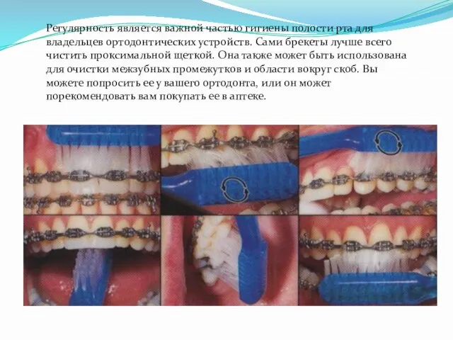 Регулярность является важной частью гигиены полости рта для владельцев ортодонтических устройств.