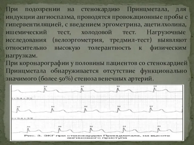 При подозрении на стенокардию Принцметала, для индукции ангиоспазма, проводятся провокационные пробы