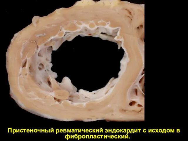 Пристеночный ревматический эндокардит с исходом в фибропластический.