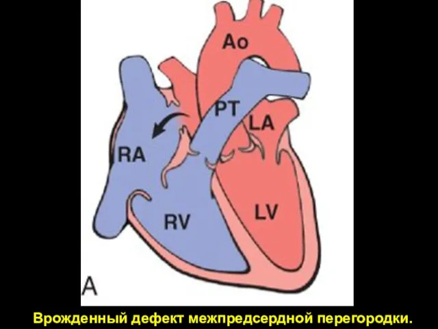 Врожденный дефект межпредсердной перегородки.