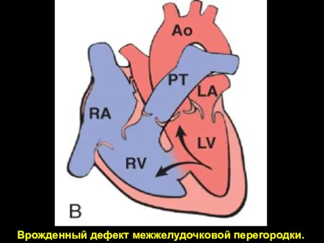 Врожденный дефект межжелудочковой перегородки.