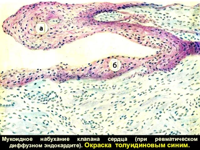 Мукоидное набухание клапана сердца (при ревматическом диффузном эндокардите). Окраска толуидиновым синим.