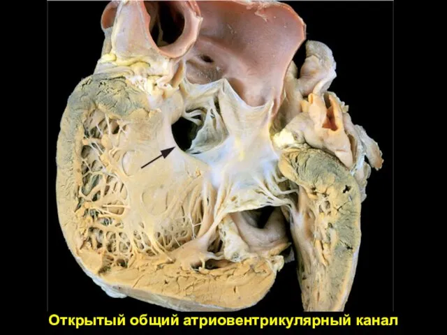 Открытый общий атриовентрикулярный канал