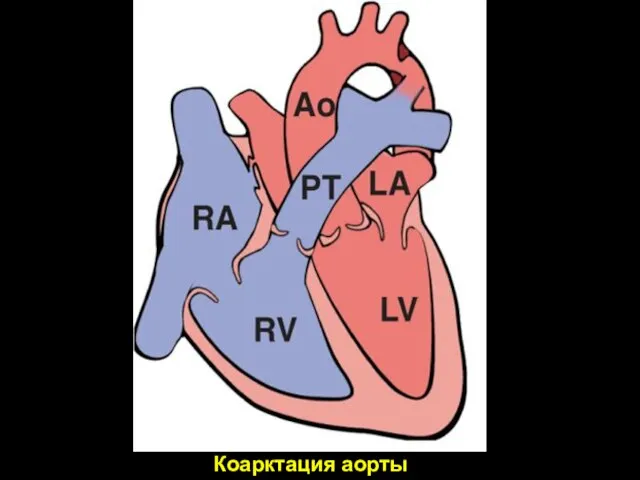 Коарктация аорты