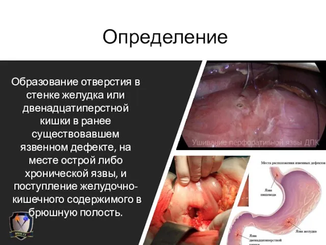 Определение Образование отверстия в стенке желудка или двенадцатиперстной кишки в ранее