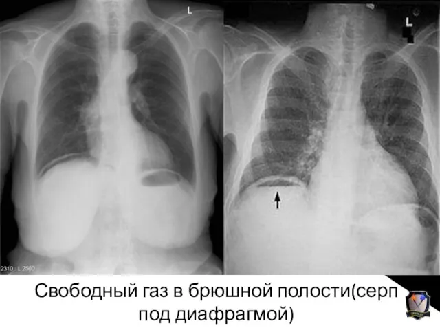 Свободный газ в брюшной полости(серп под диафрагмой)