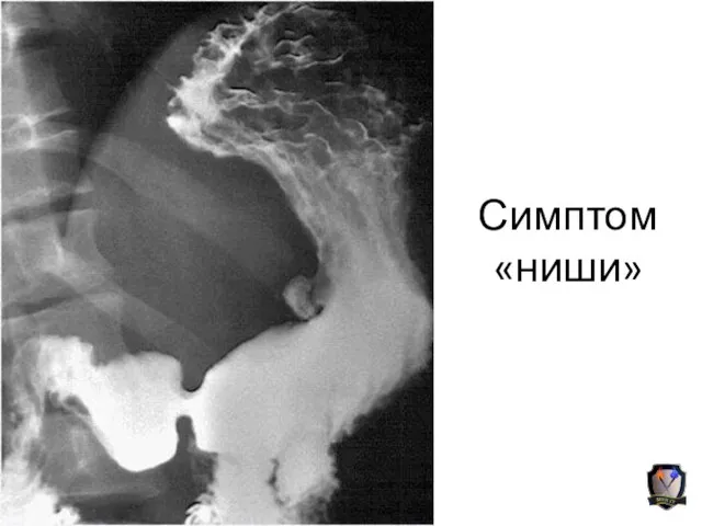 Симптом «ниши»