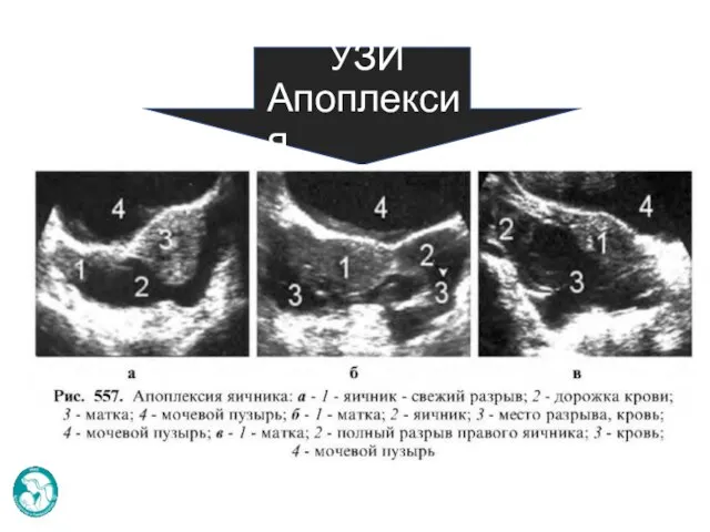 УЗИ Апоплексия