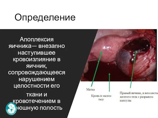 Определение Апоплексия яичника— внезапно наступившее кровоизлияние в яичник, сопровождающееся нарушением целостности