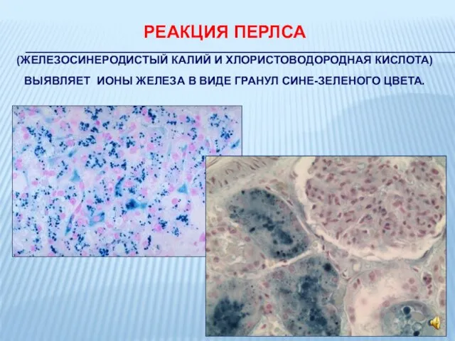 РЕАКЦИЯ ПЕРЛСА (ЖЕЛЕЗОСИНЕРОДИСТЫЙ КАЛИЙ И ХЛОРИСТОВОДОРОДНАЯ КИСЛОТА) ВЫЯВЛЯЕТ ИОНЫ ЖЕЛЕЗА В ВИДЕ ГРАНУЛ СИНЕ-ЗЕЛЕНОГО ЦВЕТА.