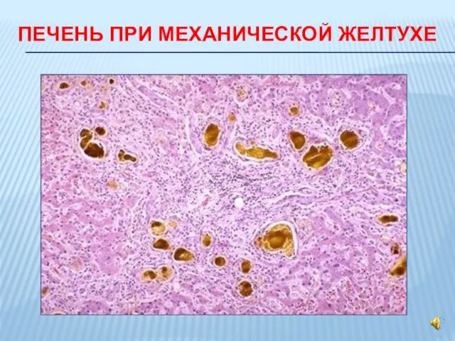 ПЕЧЕНЬ ПРИ МЕХАНИЧЕСКОЙ ЖЕЛТУХЕ