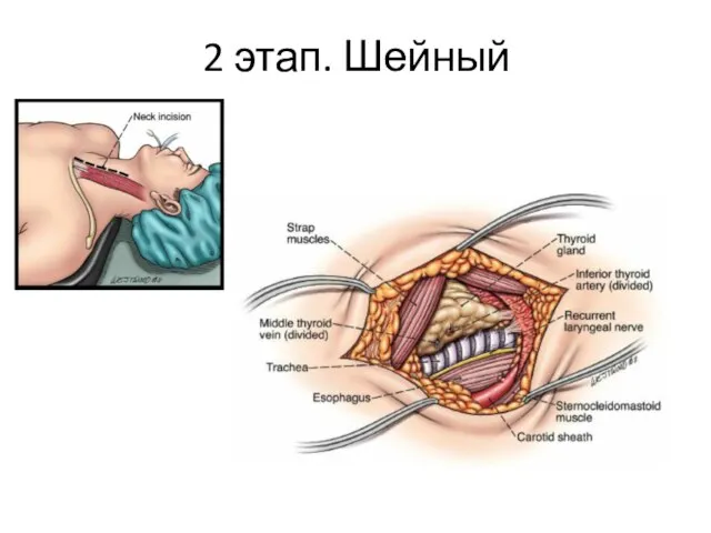 2 этап. Шейный