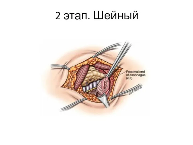 2 этап. Шейный