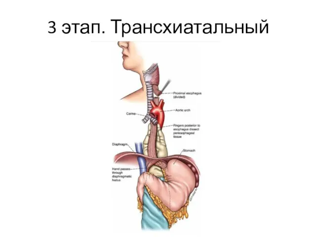 3 этап. Трансхиатальный