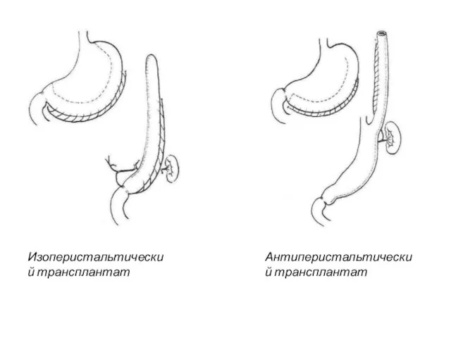 Изоперистальтический трансплантат Антиперистальтический трансплантат