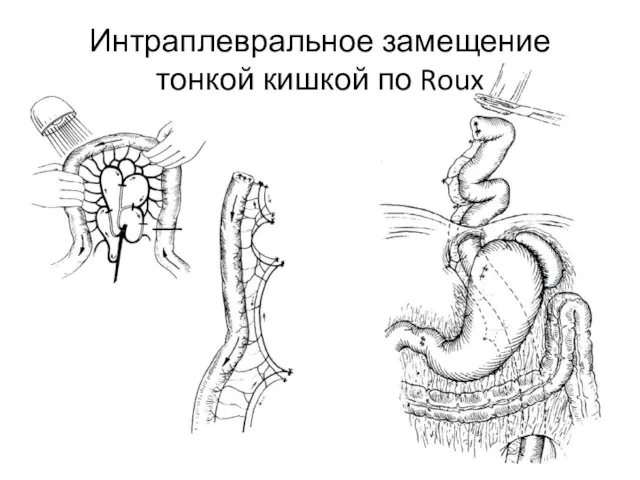 Интраплевральное замещение тонкой кишкой по Roux