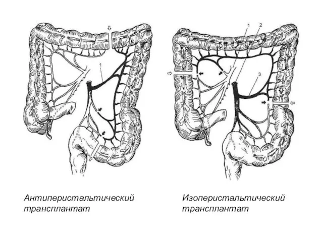 Антиперистальтический трансплантат Изоперистальтический трансплантат