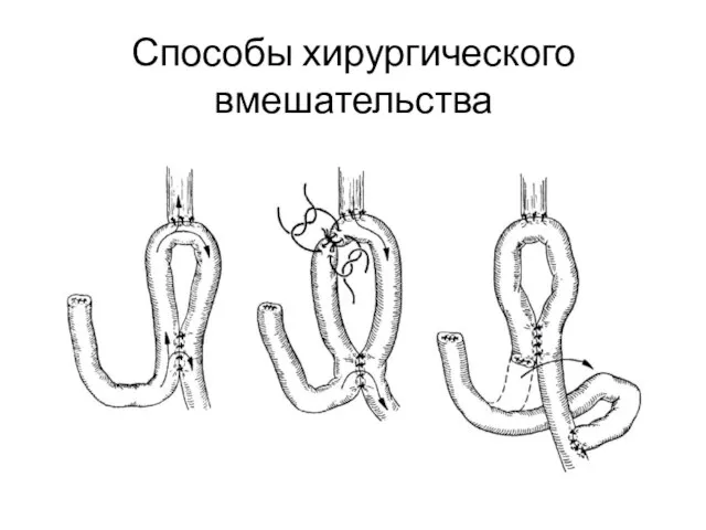 Способы хирургического вмешательства