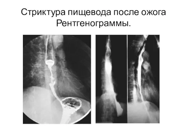 Стриктура пищевода после ожога Рентгенограммы.