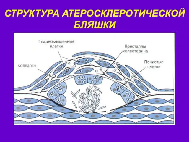 СТРУКТУРА АТЕРОСКЛЕРОТИЧЕСКОЙ БЛЯШКИ