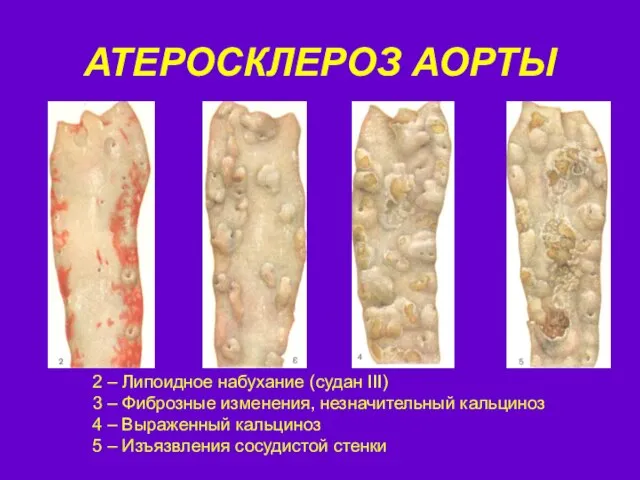 АТЕРОСКЛЕРОЗ АОРТЫ 2 – Липоидное набухание (судан III) 3 – Фиброзные