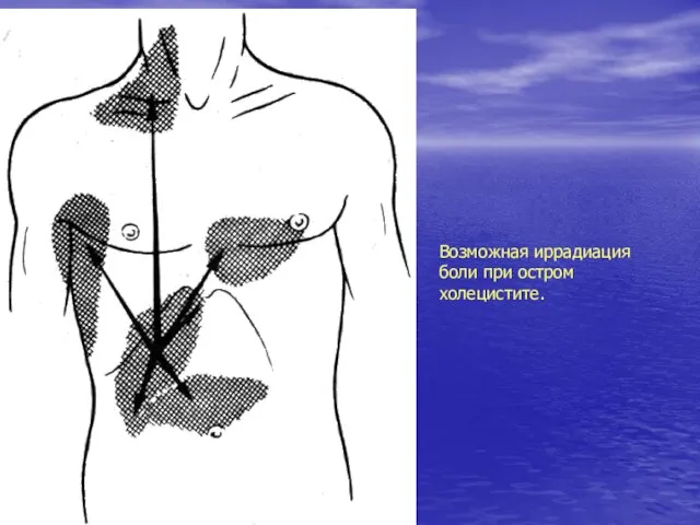 Возможная иррадиация боли при остром холецистите.