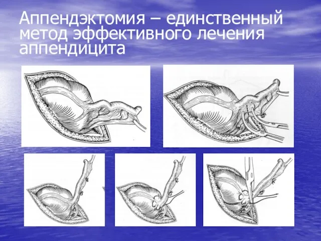 Аппендэктомия – единственный метод эффективного лечения аппендицита