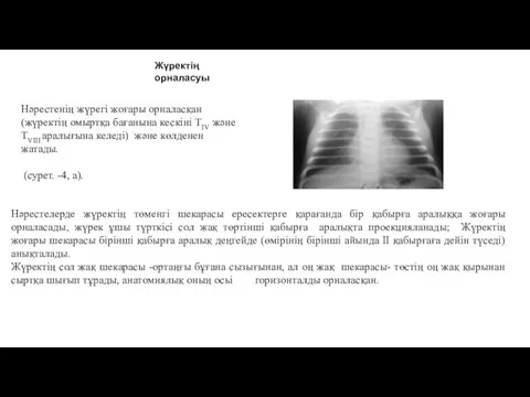 Жүректің орналасуы Нәрестенің жүрегі жоғары орналасқан (жүректің омыртқа бағанына кескіні TIV