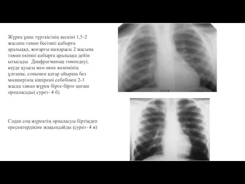 Жүрек ұшы түрткісінің кескіні 1,5-2 жасына таман бесінші қабырға аралыққа, жоғарғы