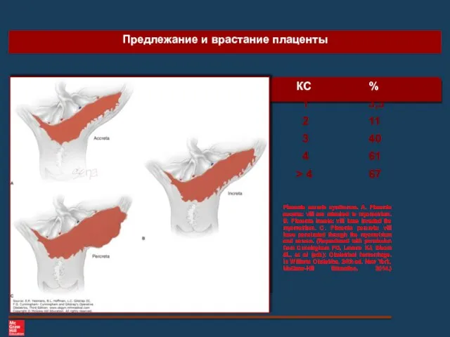 Предлежание и врастание плаценты КС % 1 3,3 2 11 3