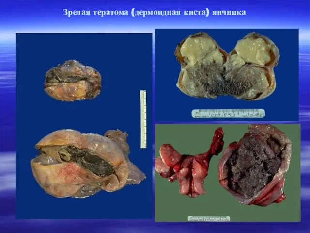 Зрелая тератома (дермоидная киста) яичника