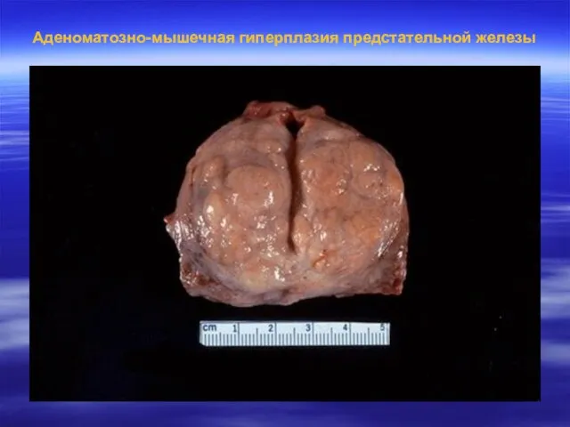 Аденоматозно-мышечная гиперплазия предстательной железы