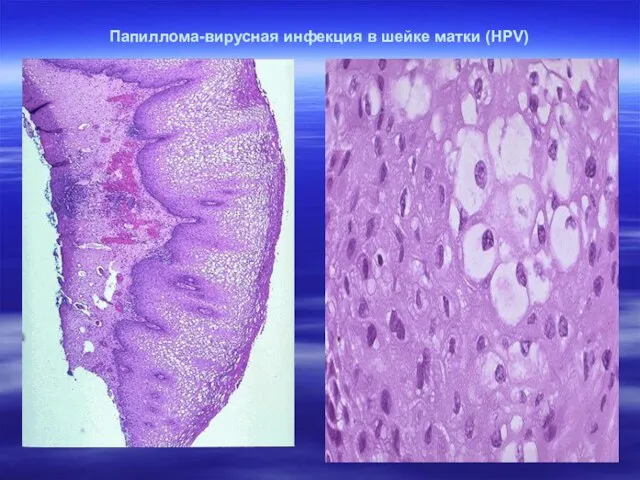 Папиллома-вирусная инфекция в шейке матки (HPV)