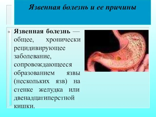 Язвенная болезнь и ее причины Язвенная болезнь — общее, хронически рецидивирующее