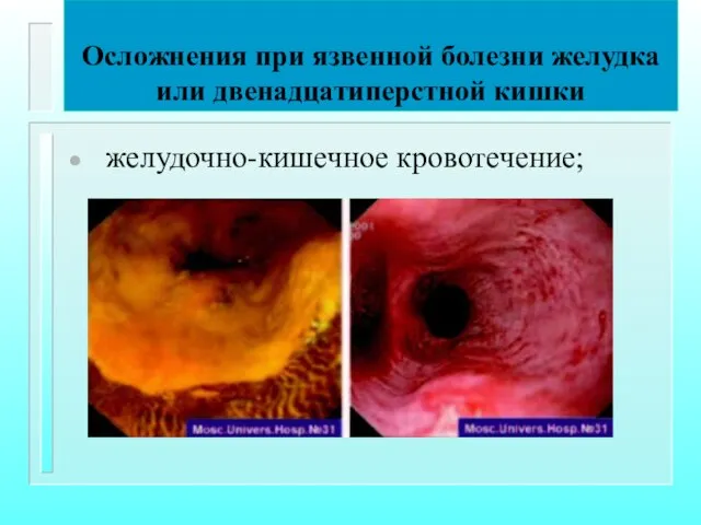 Осложнения при язвенной болезни желудка или двенадцатиперстной кишки желудочно-кишечное кровотечение;