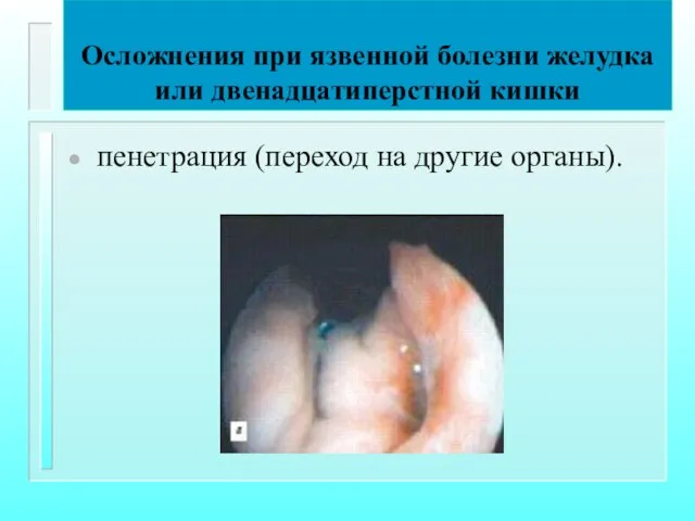 Осложнения при язвенной болезни желудка или двенадцатиперстной кишки пенетрация (переход на другие органы).
