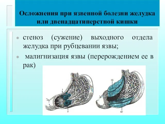 Осложнения при язвенной болезни желудка или двенадцатиперстной кишки стеноз (сужение) выходного