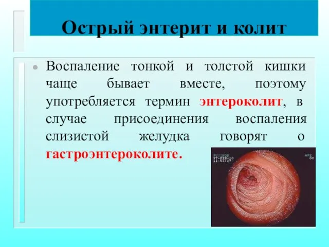 Острый энтерит и колит Воспаление тонкой и толстой кишки чаще бывает