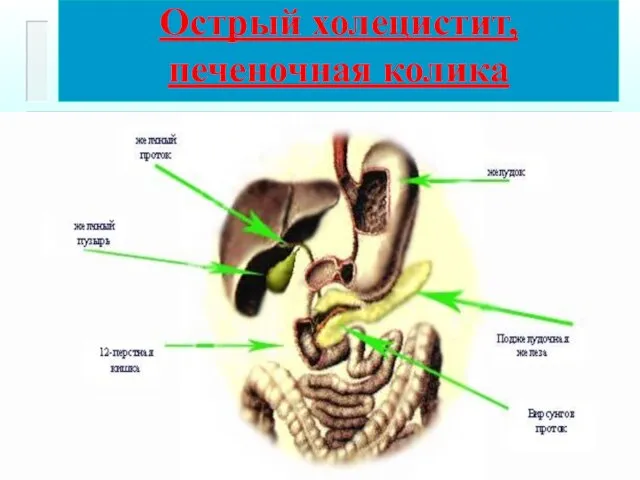 Острый холецистит, печеночная колика