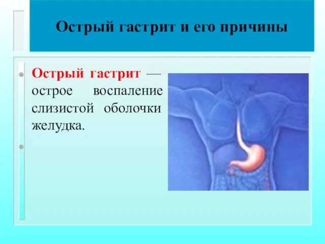 Острый гастрит и его причины Острый гастрит — острое воспаление слизистой оболочки желудка.