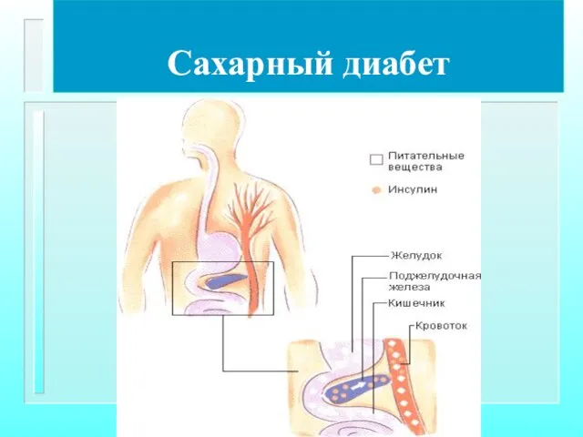 Сахарный диабет