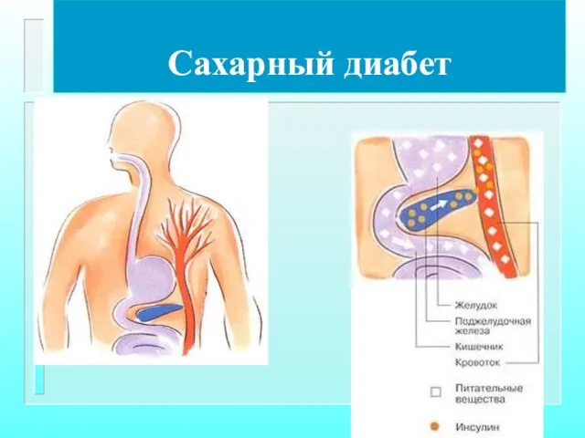 Сахарный диабет