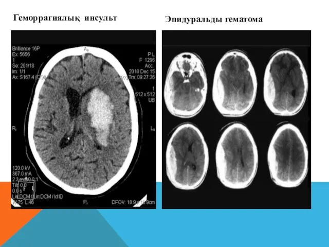 Геморрагиялық инсульт Эпидуральды гематома