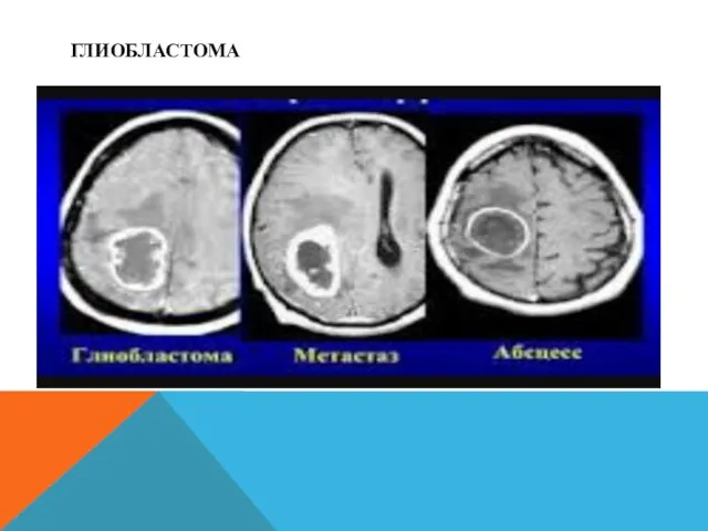ГЛИОБЛАСТОМА